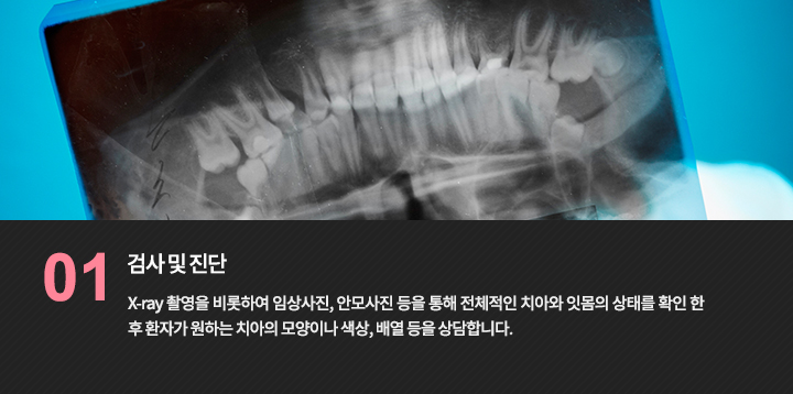 -검사 및 진단
X-ray 촬영을 비롯하여 임상사진, 안모사진 등을 통해 전체적인 치아와 잇몸의 상태를 확인 한 후 환자가 원하는 치아의 모양이나 색상, 배열 등을 상담합니다.