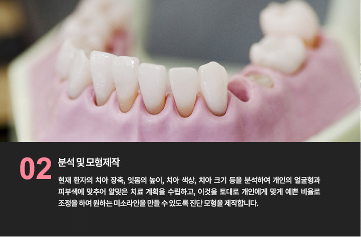 분석 및 모형제작
현재 환자의 치아 장축, 잇몸의 높이, 치아 색상, 치아 크기 등을 분석하여 개인의 얼굴형과 피부색에 맞추어 알맞은 치료 계획을 수립하고, 이것을 토대로 개인에게 맞게 예쁜 비율로 조정을 하여 원하는 미소라인을 만들 수 있도록 진단 모형을 제작합니다.
