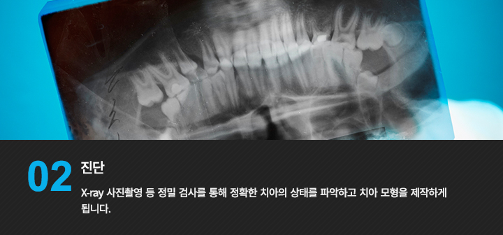 2. 진단 
X-ray 사진촬영 등 정밀 검사를 통해 정확한 치아의 상태를 파악하고 치아 모형을 제작하게 됩니다.